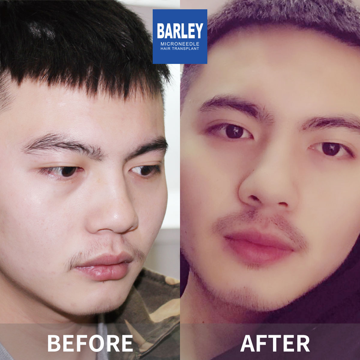 Female Hairline Restoration