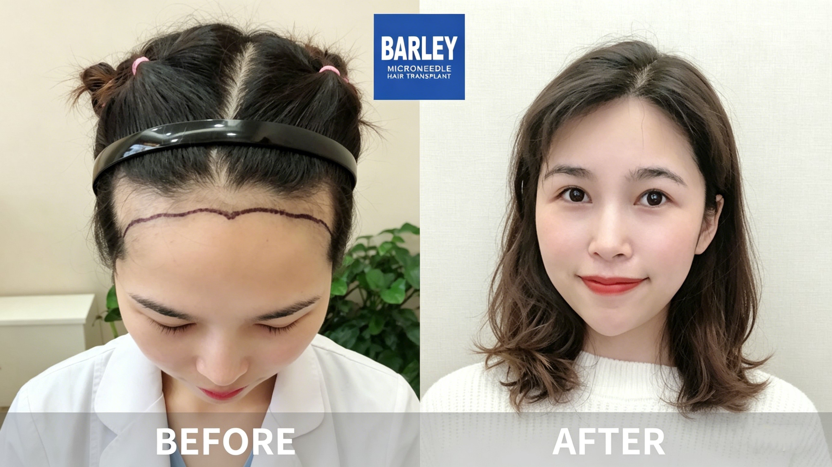 Dramatic Density Improvement