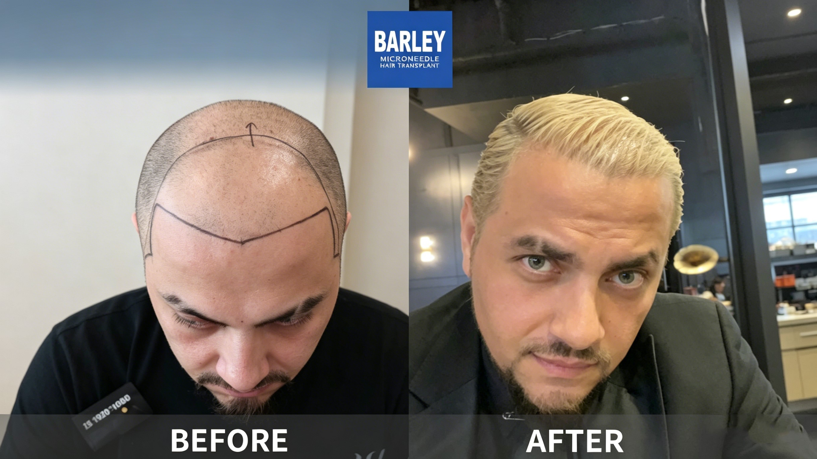 Amazing Hair Transplant Journey