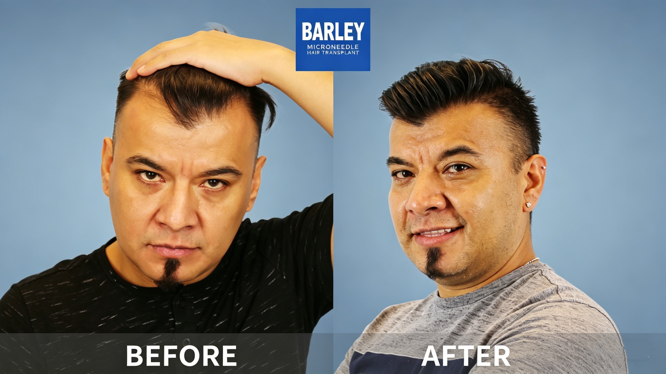 Complete Hairline Transformation