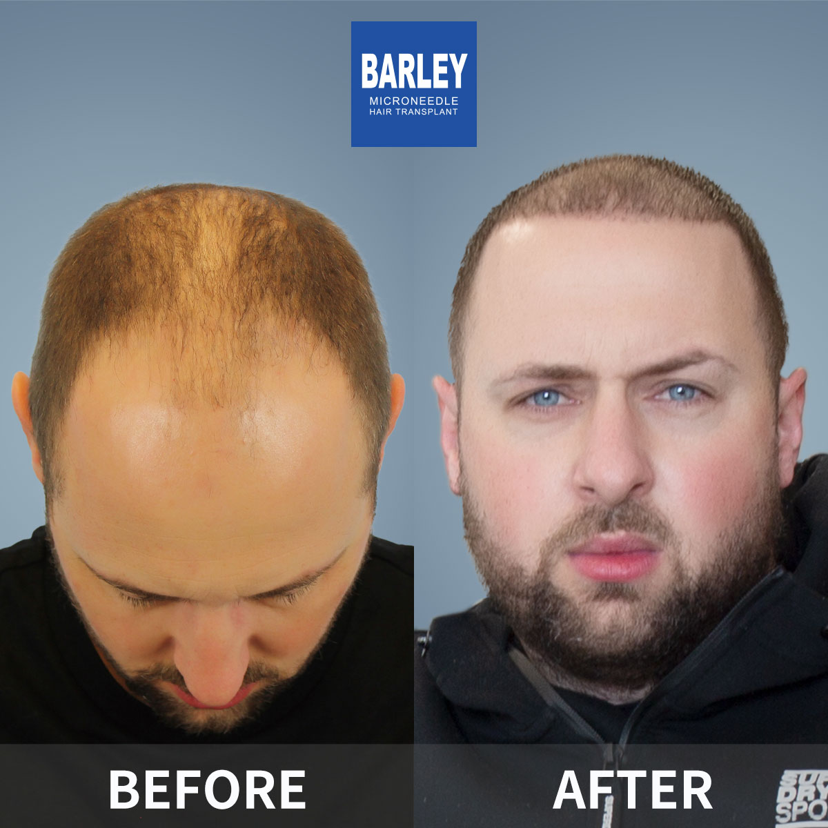 Crown Density Enhancement