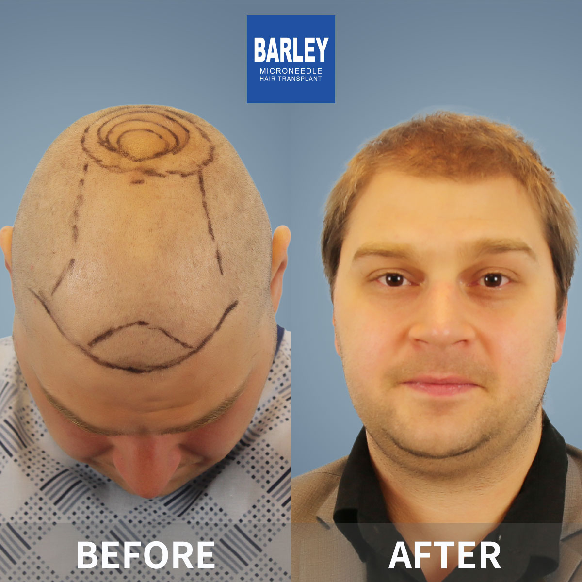 Natural Hairline Restoration