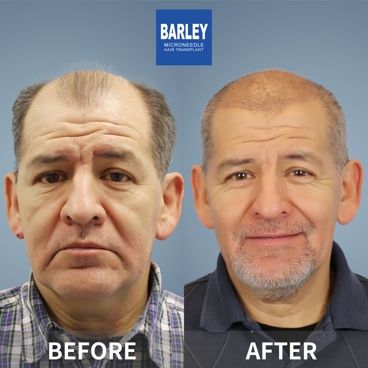 Crown Density Enhancement