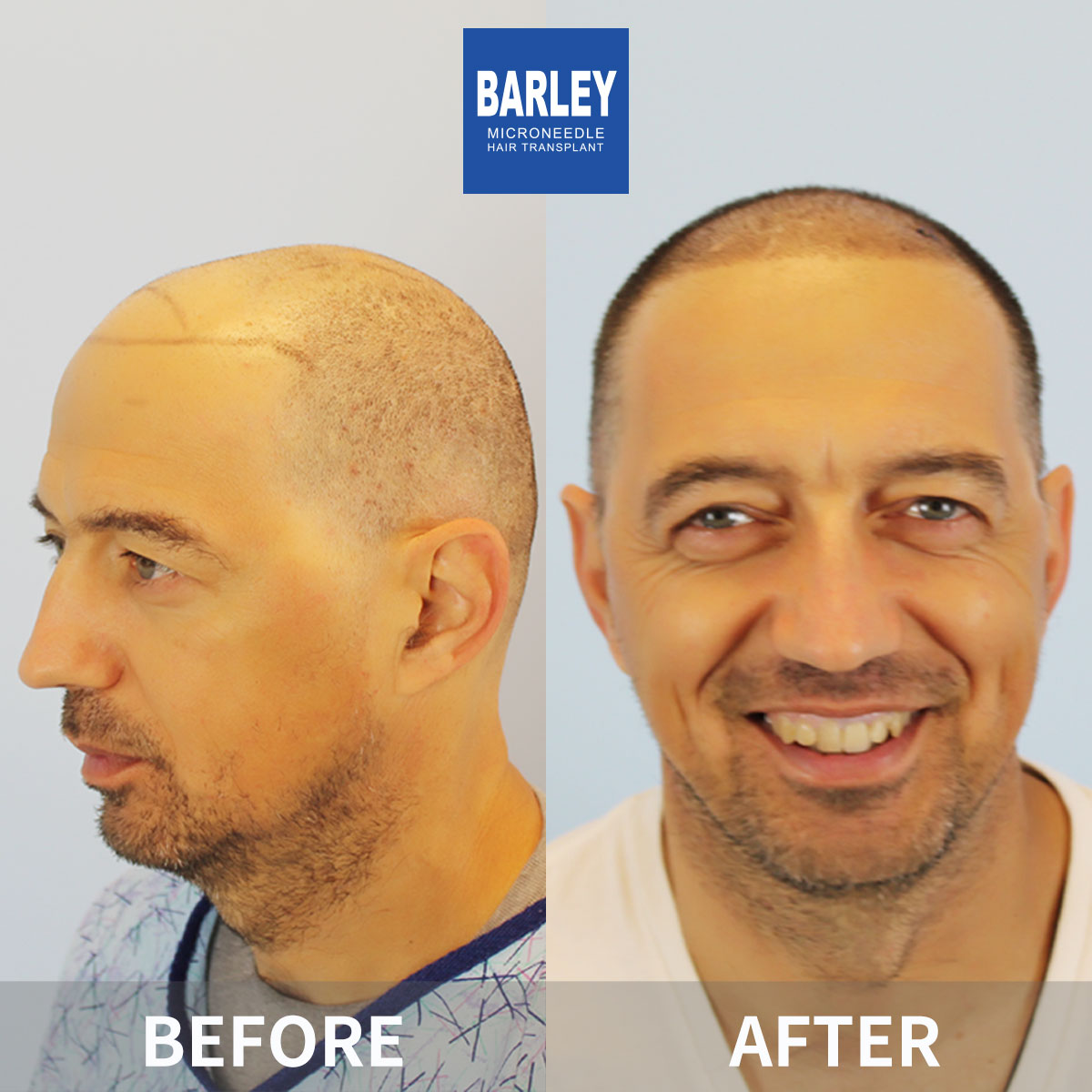 Complete Baldness Transformation