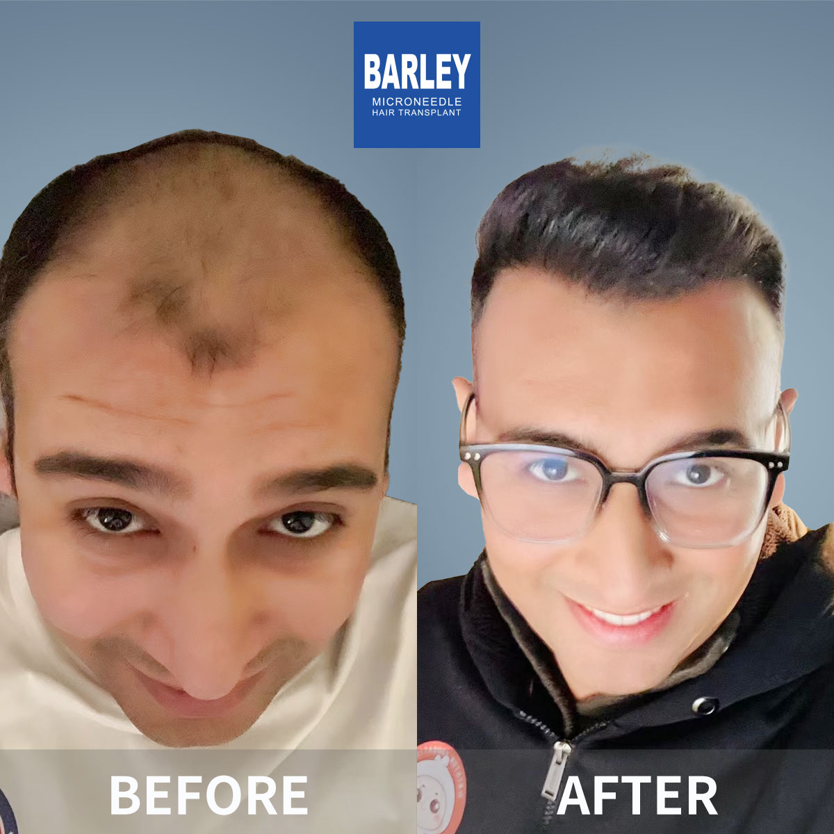 Eyebrow Transplant Before & After