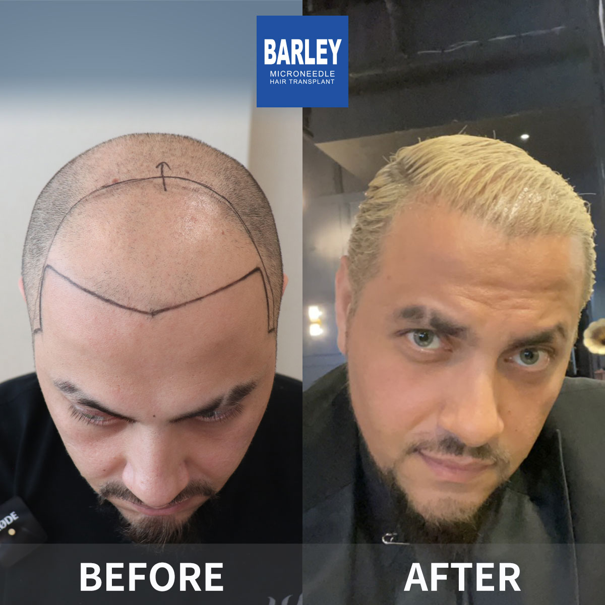 Natural Hairline Restoration