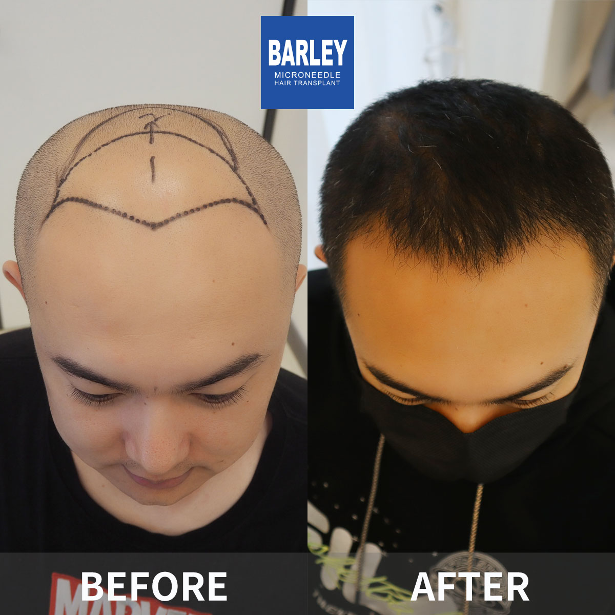Female Hairline Restoration