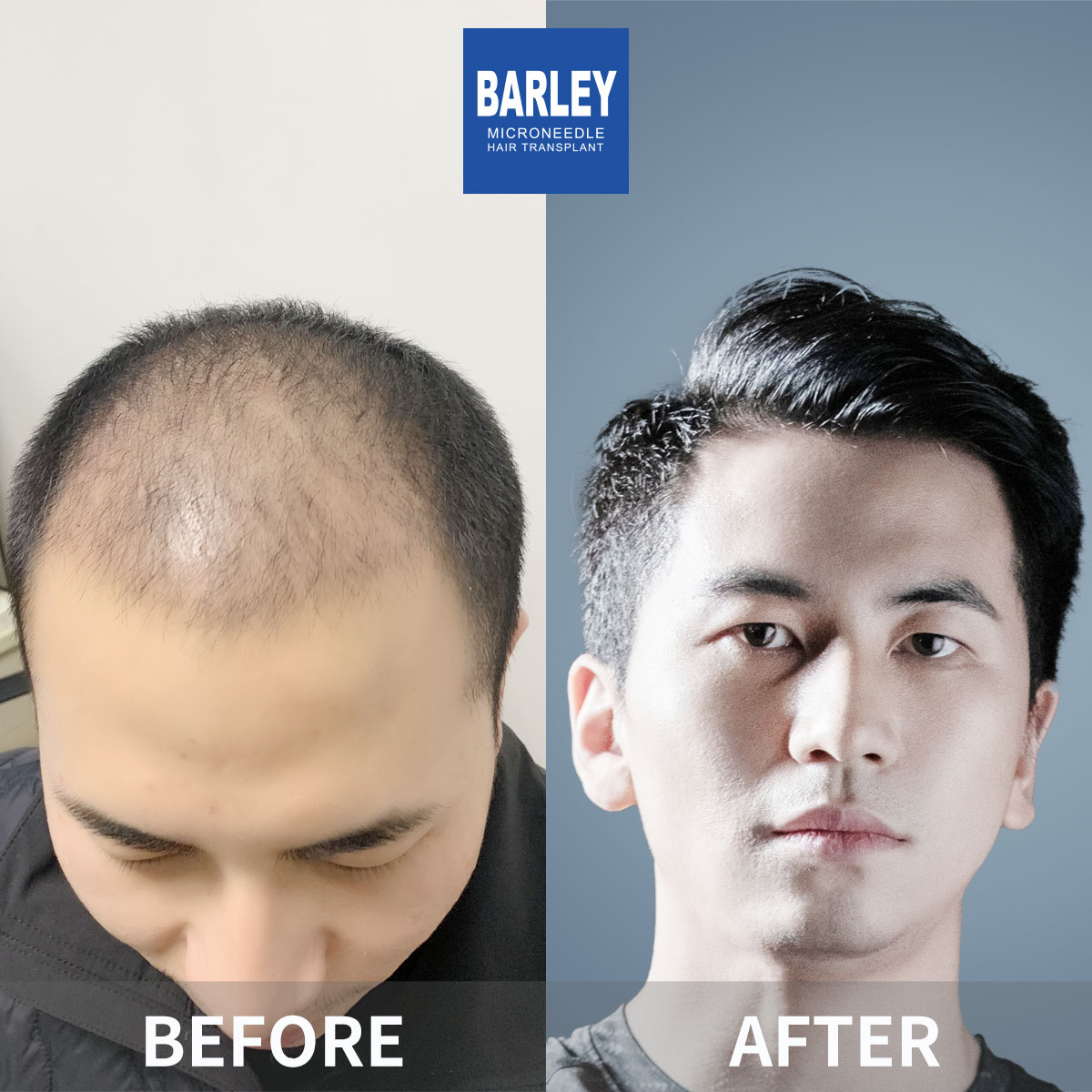 Complete Baldness Transformation