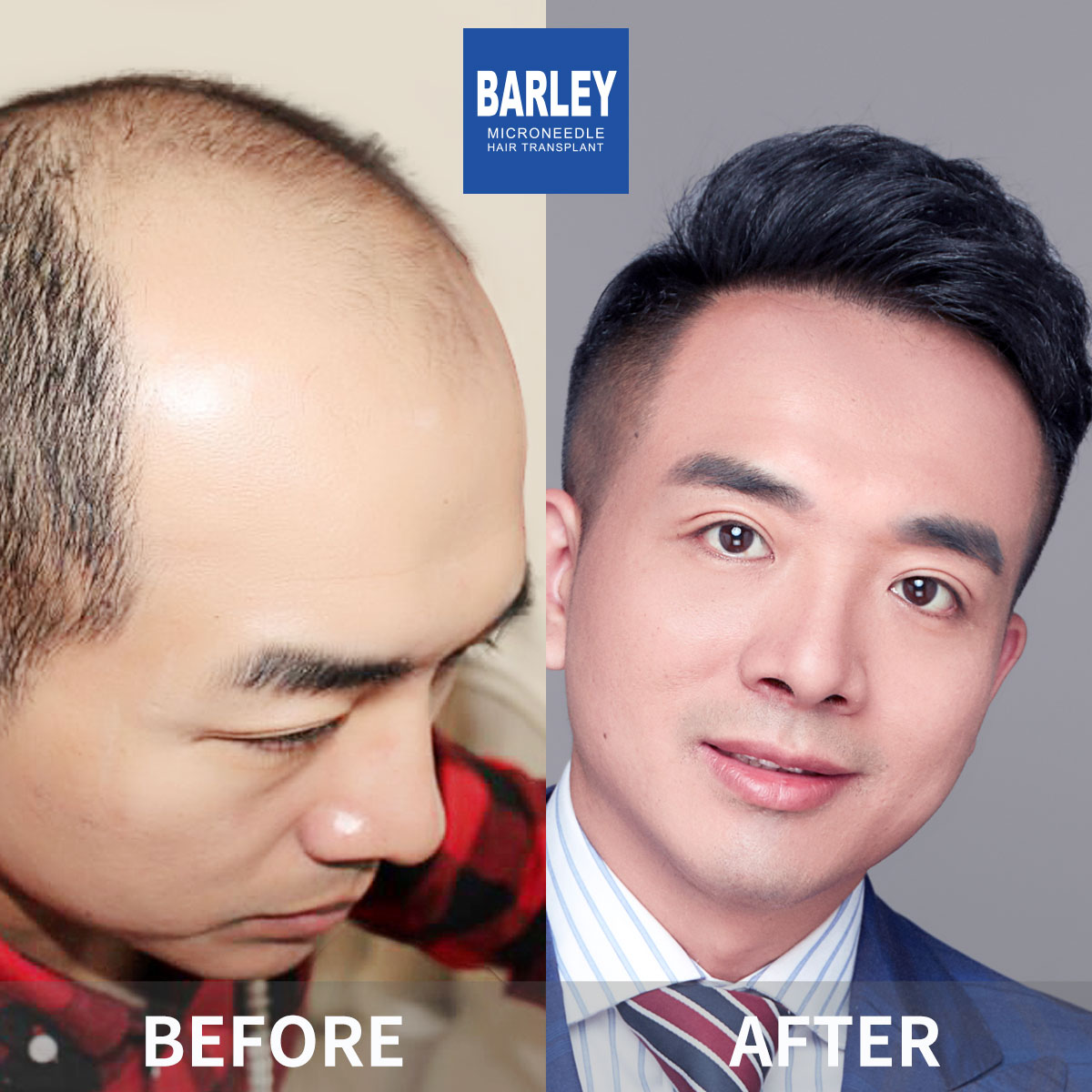 Natural Hairline Restoration