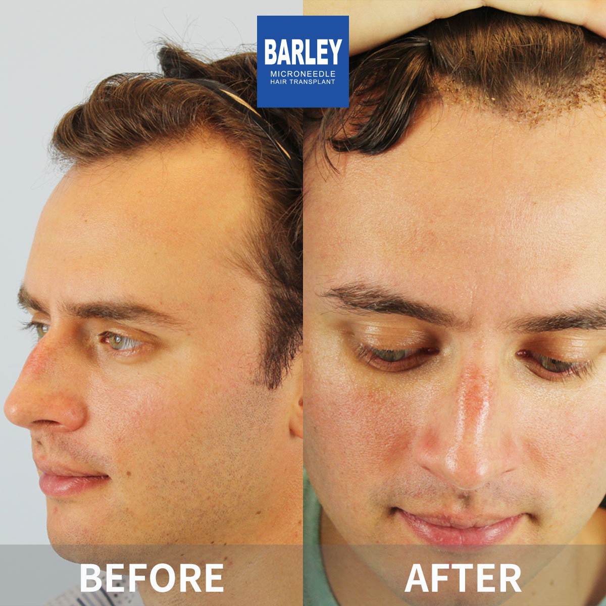 Beard Transplant Results