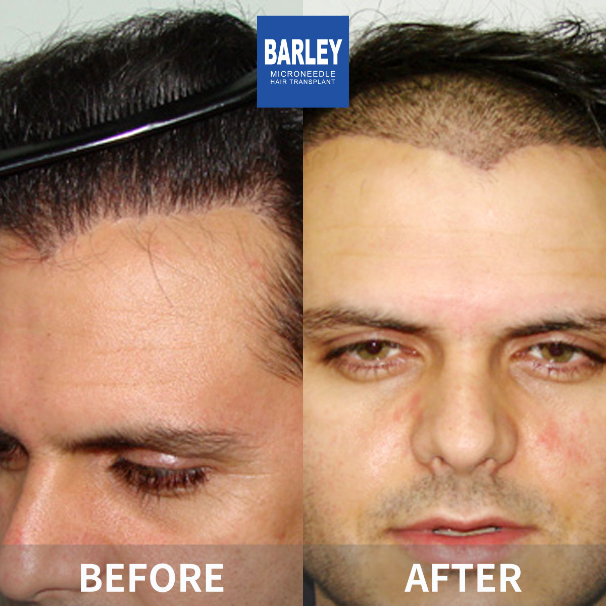 Female Hairline Restoration