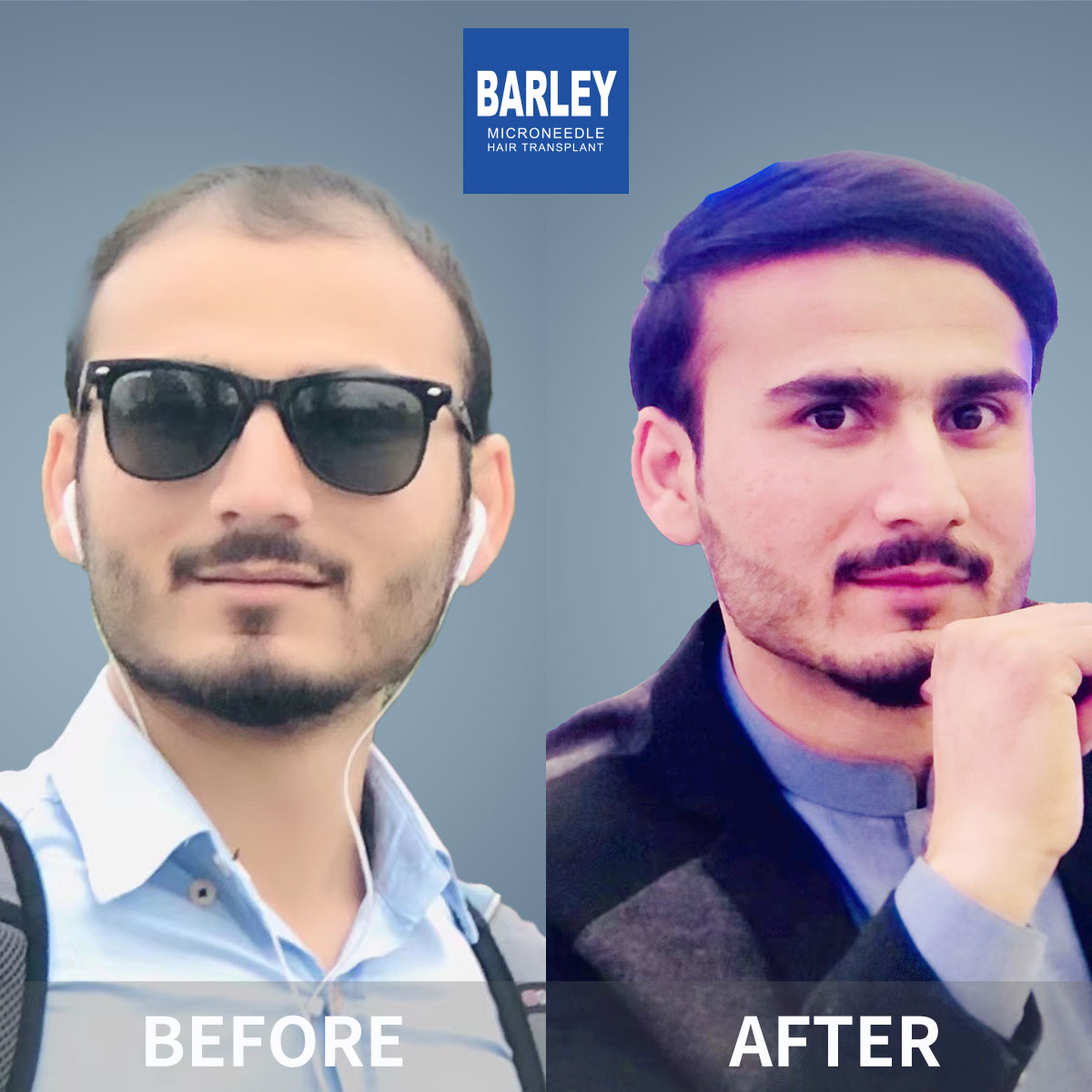 Crown Density Enhancement