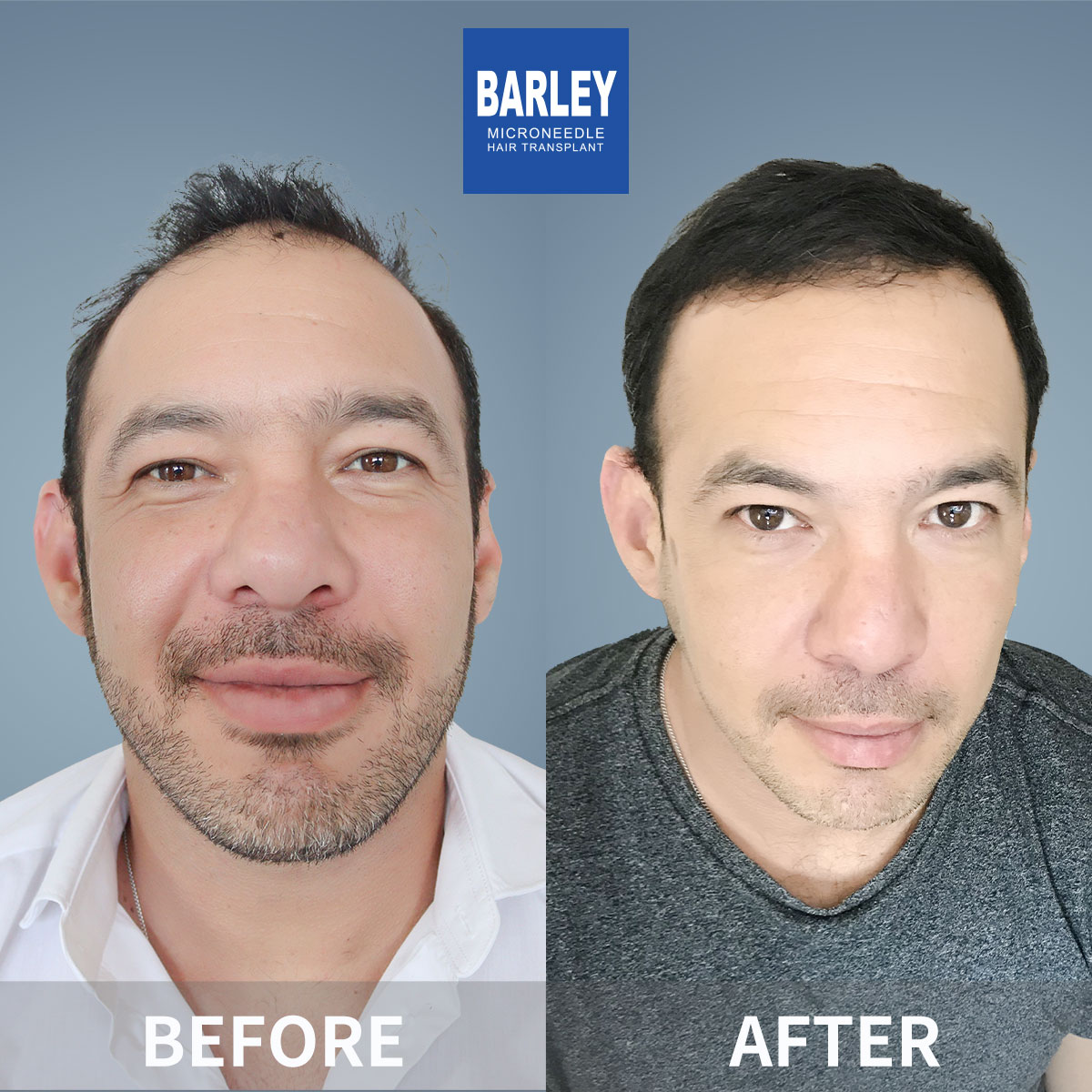 Beard Transplant Results
