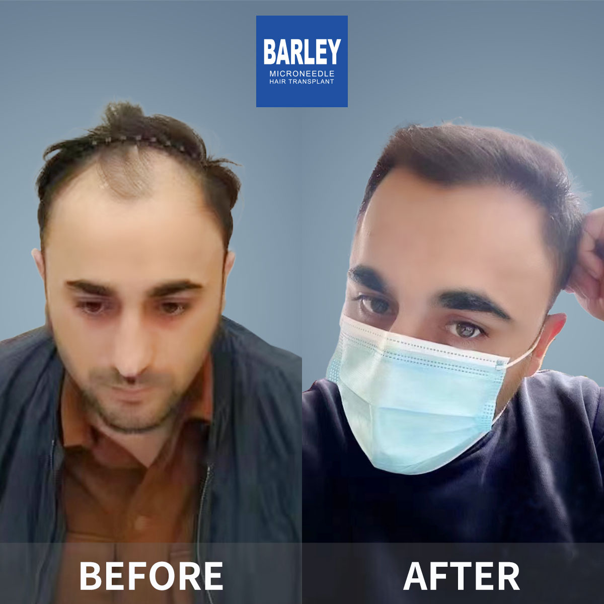 Beard Transplant Results