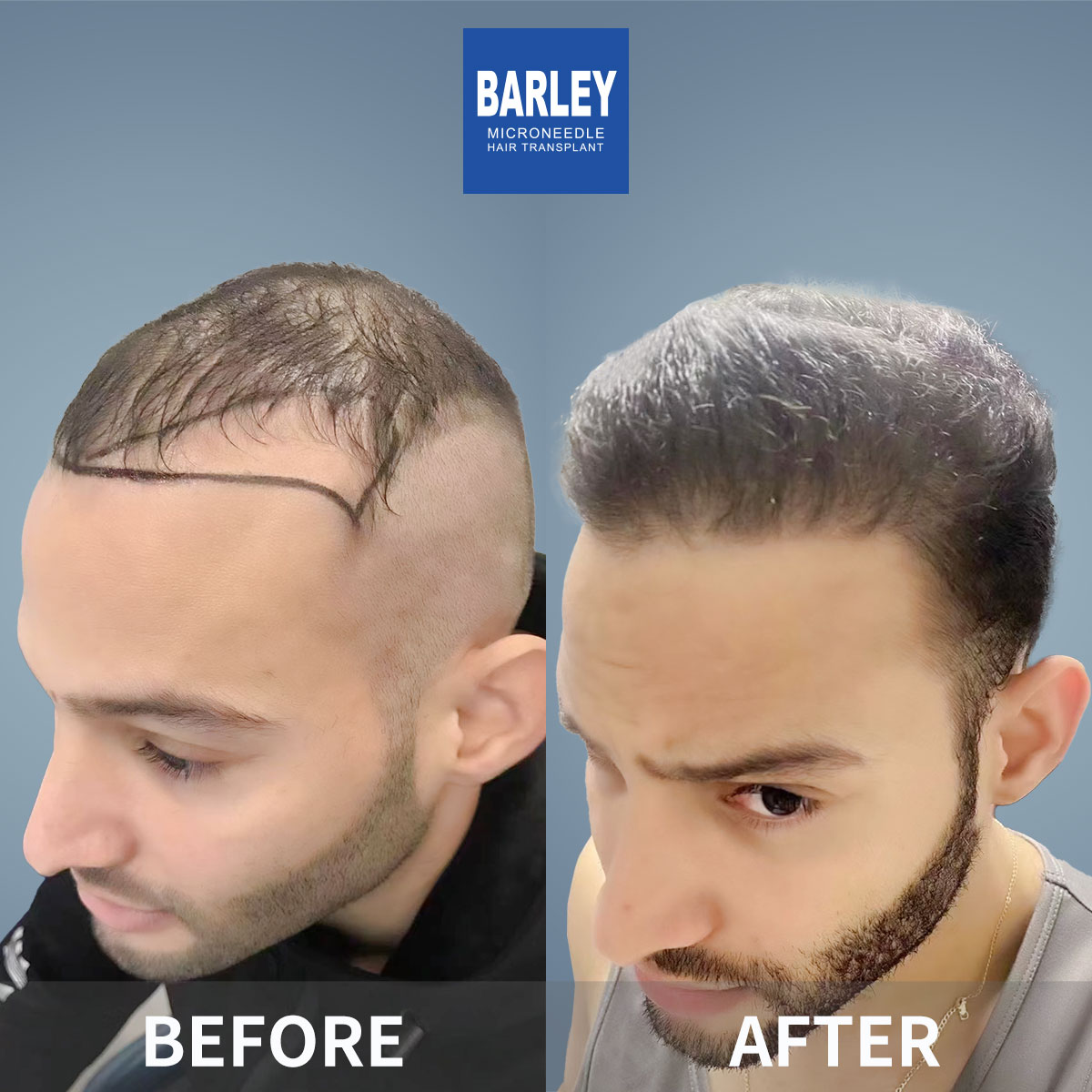 Crown Density Enhancement