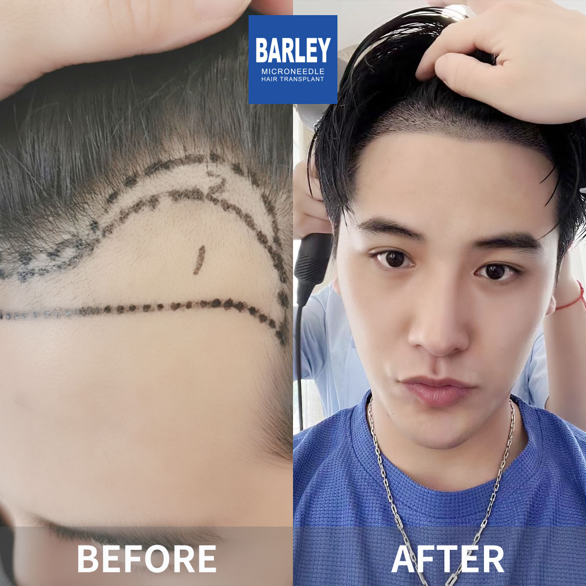 Beard Transplant Results