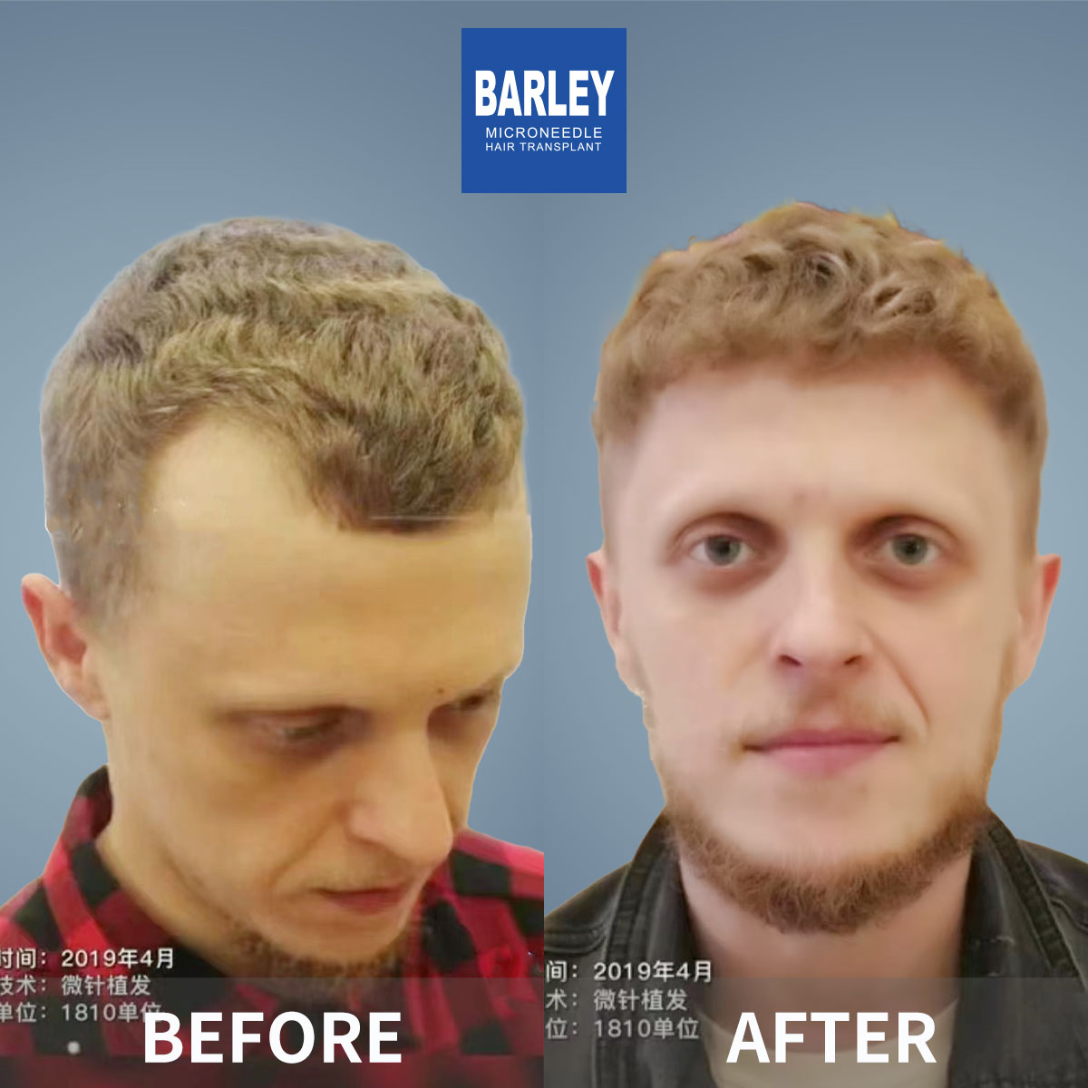 Natural Hairline Restoration