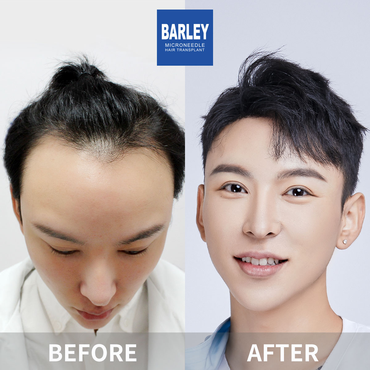 Complete Baldness Transformation