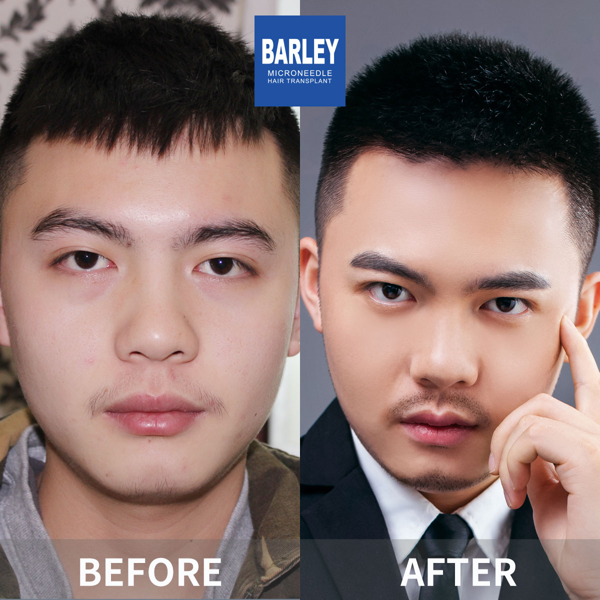 Female Hairline Restoration