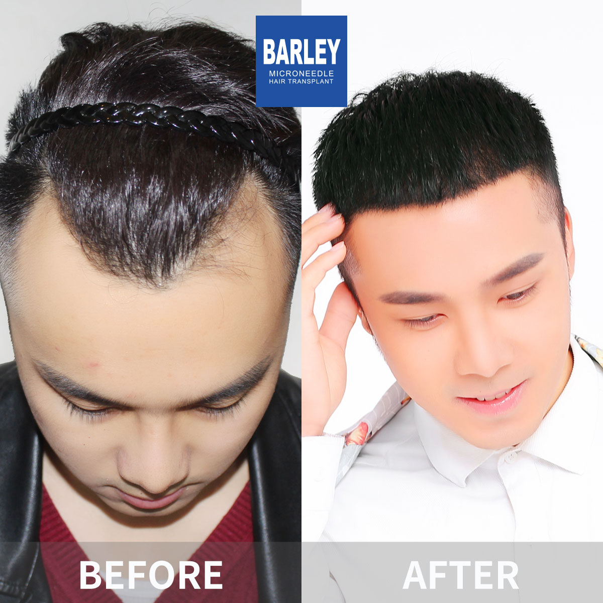 Female Hairline Restoration