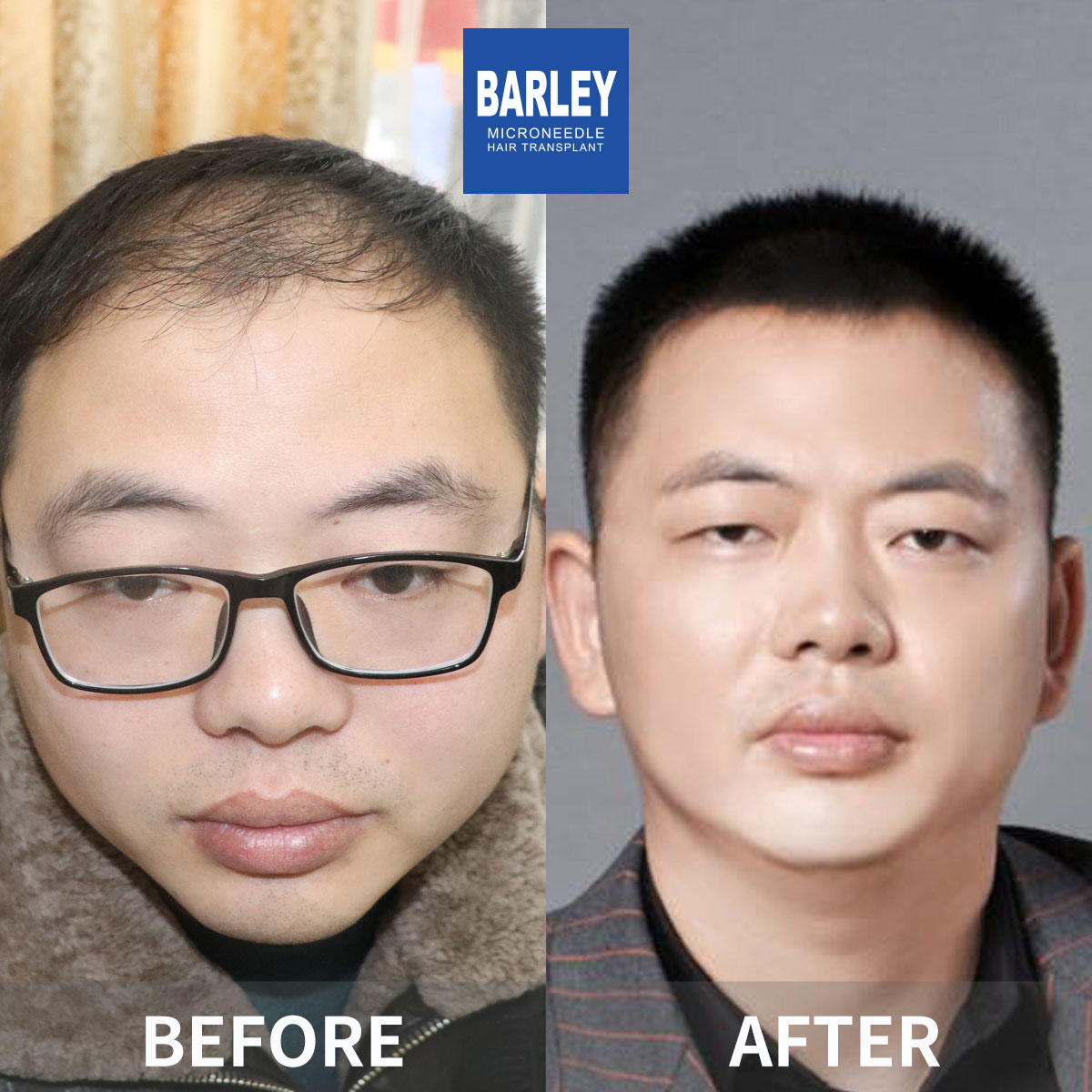 Eyebrow Transplant Before & After