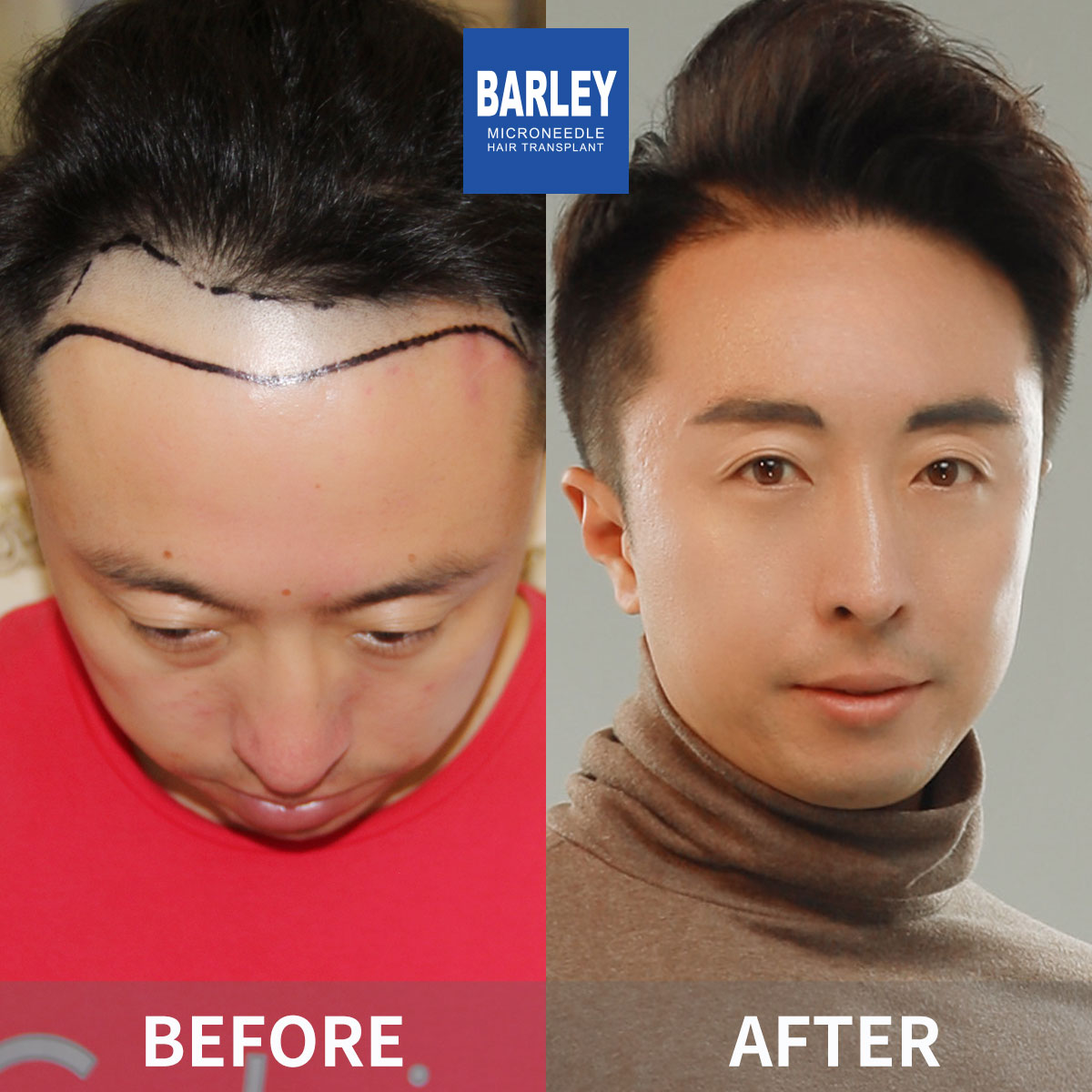 Complete Baldness Transformation