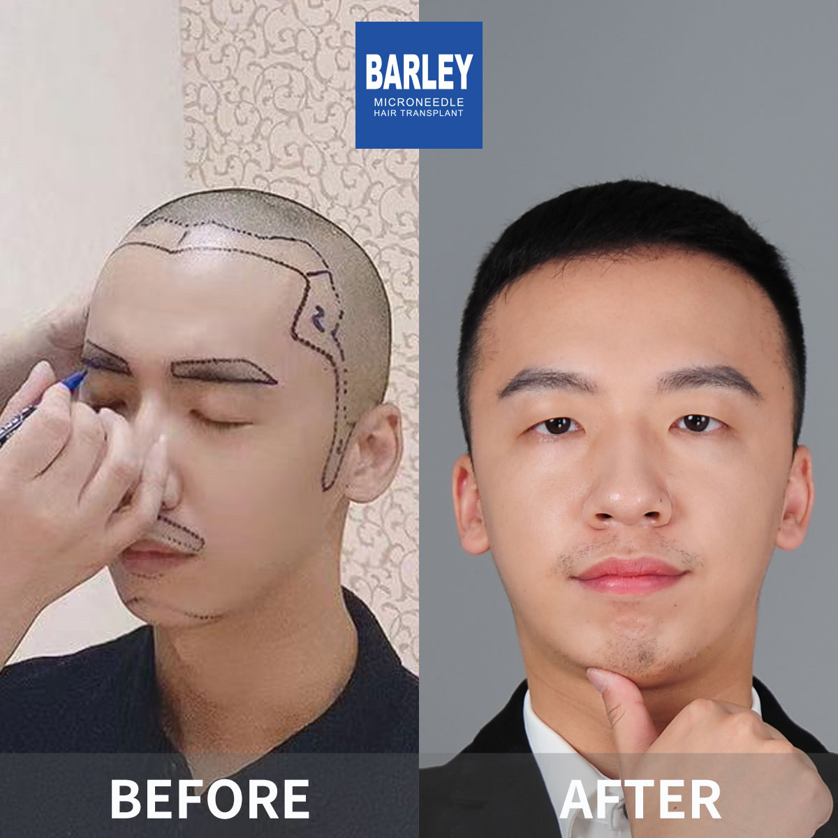 Eyebrow Transplant Before & After