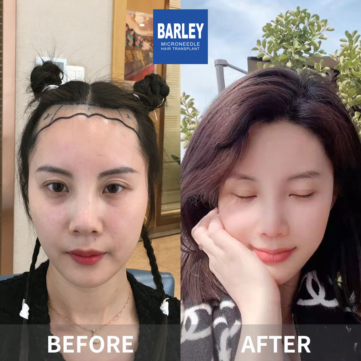 Crown Density Enhancement