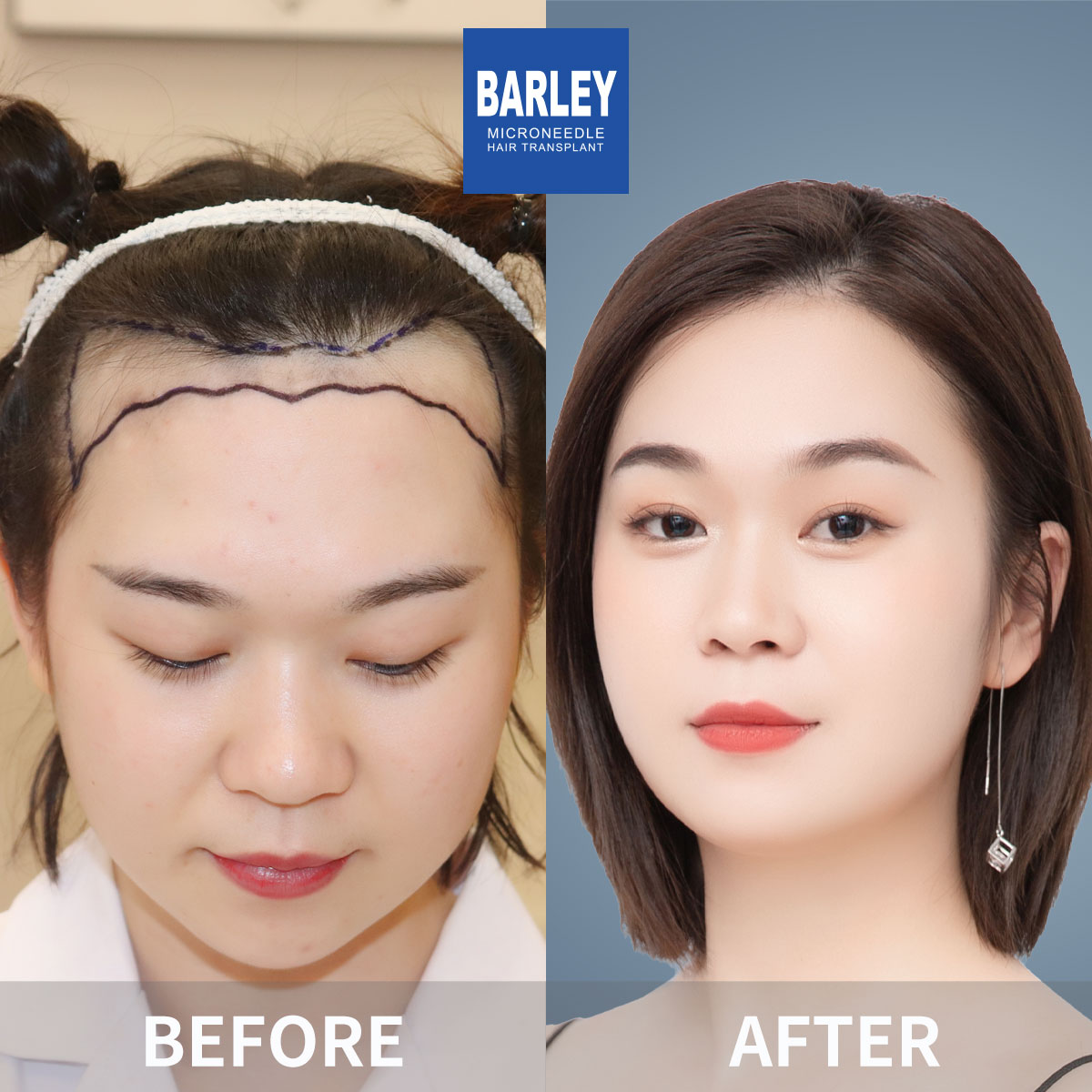 Beard Transplant Results