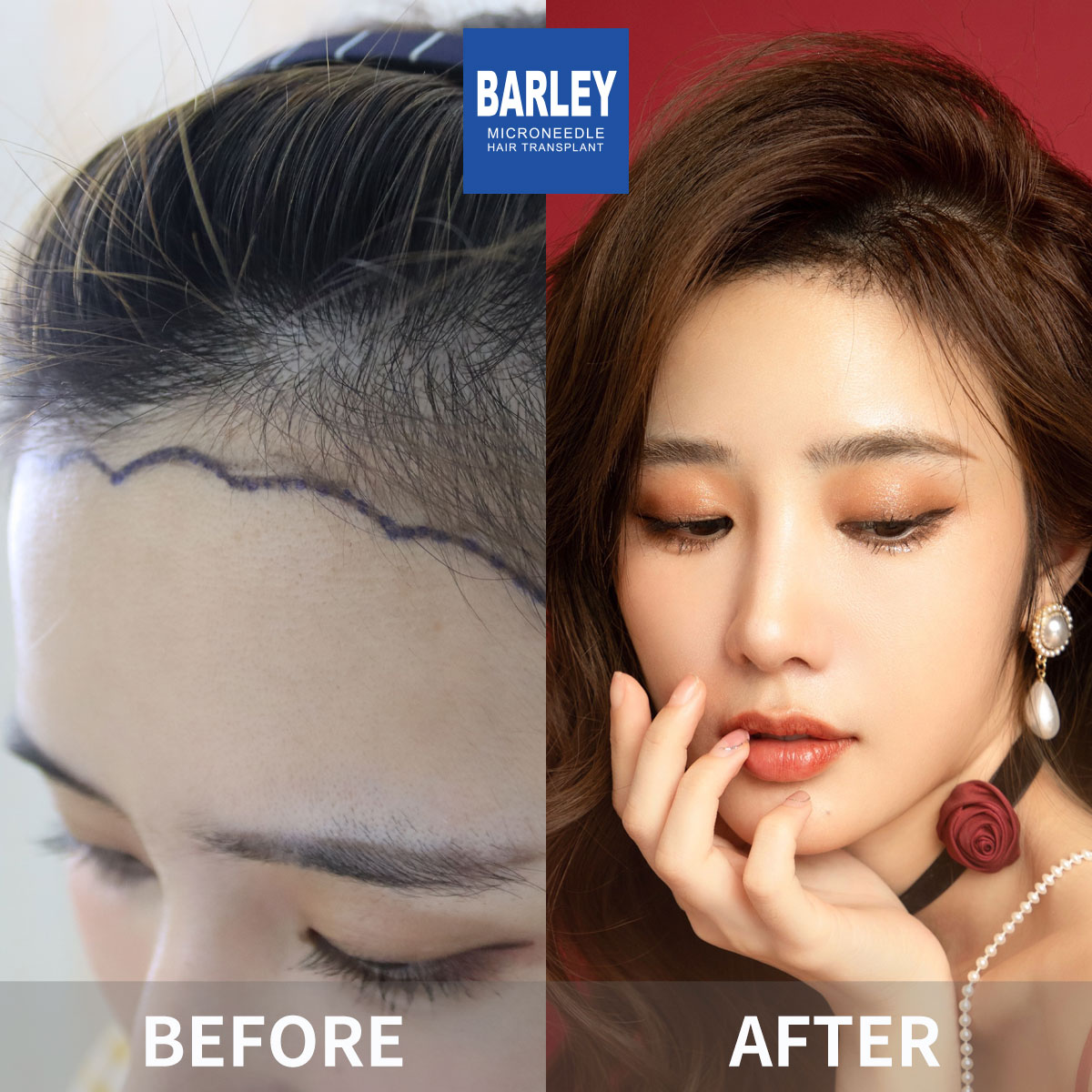 Complete Baldness Transformation