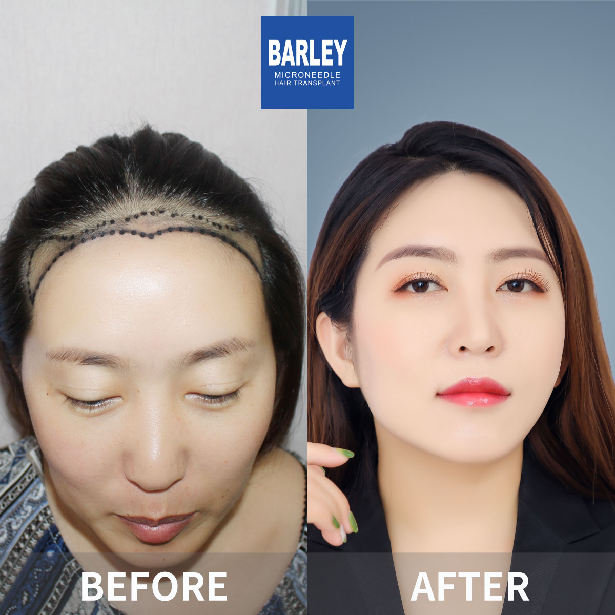 Natural Hairline Restoration