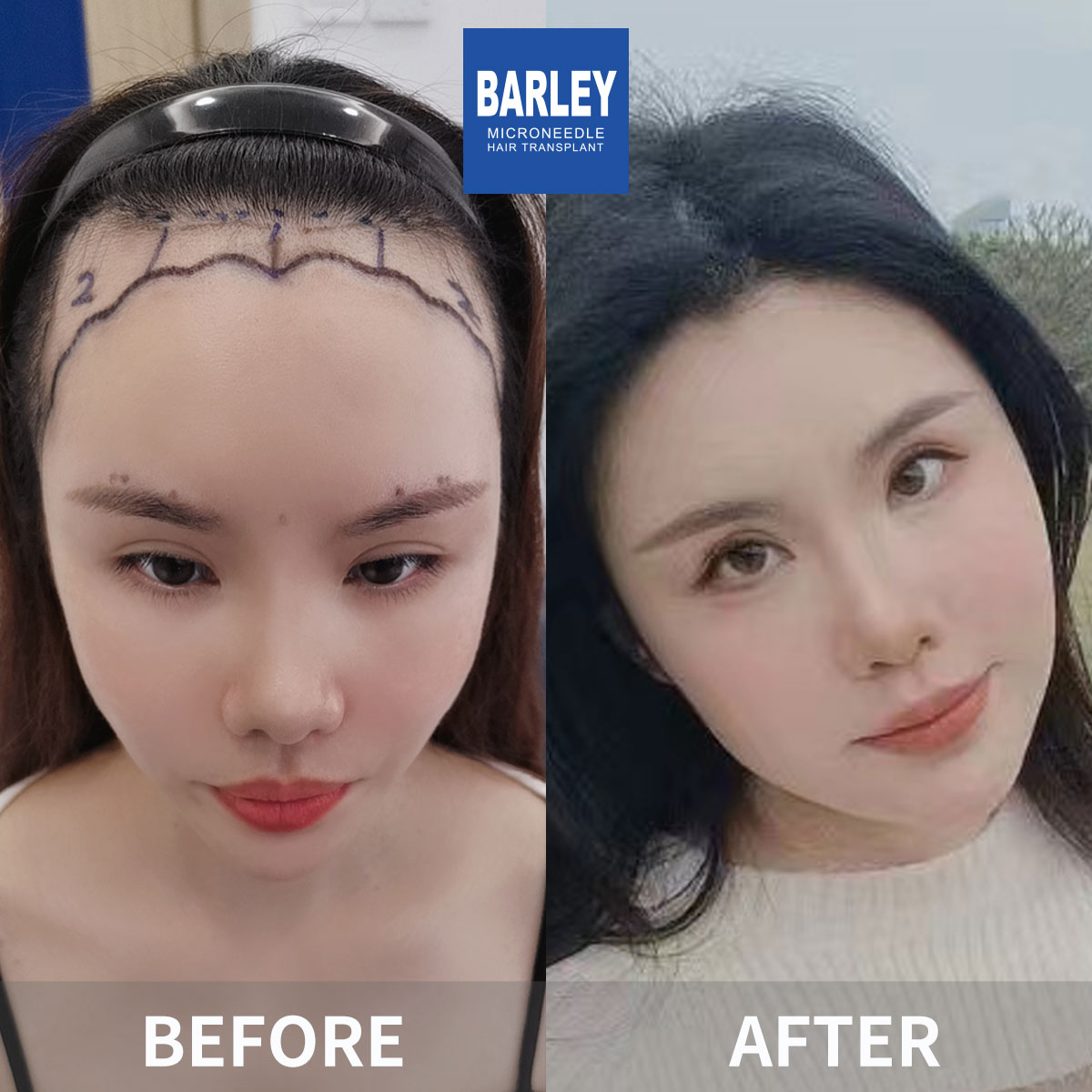 Eyebrow Transplant Before & After