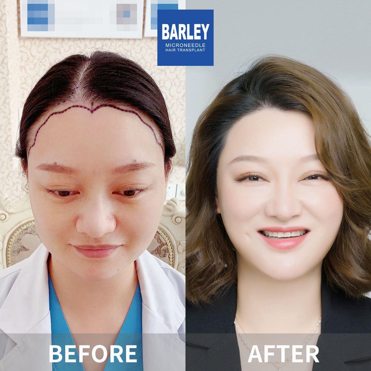 Female Hairline Restoration