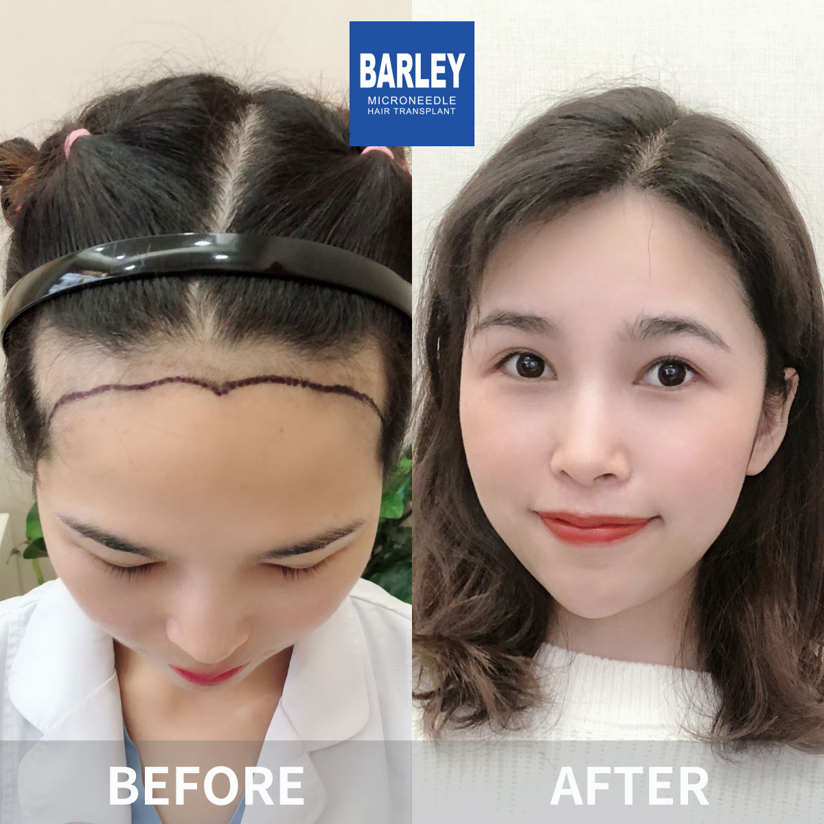 Eyebrow Transplant Before & After