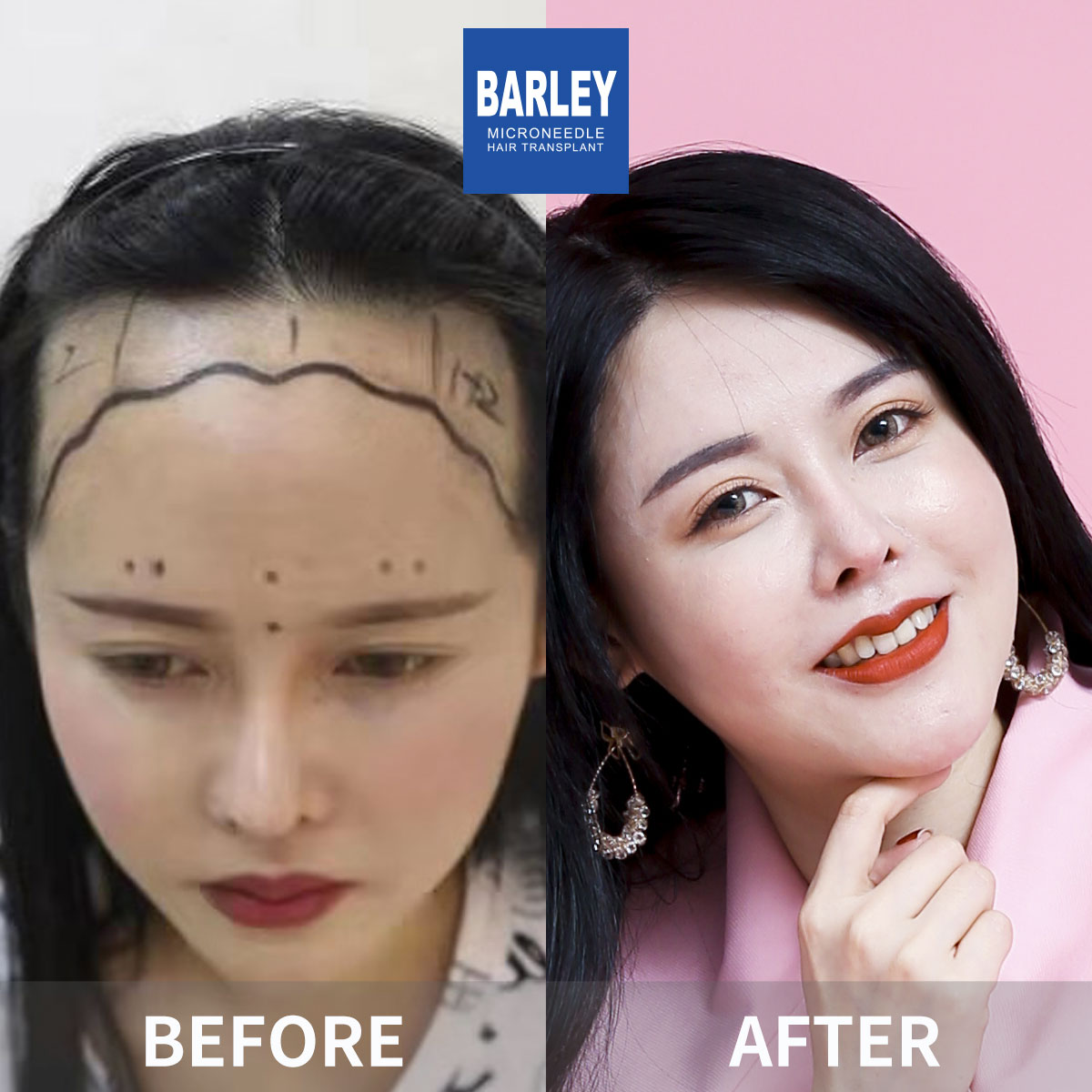 Crown Density Enhancement