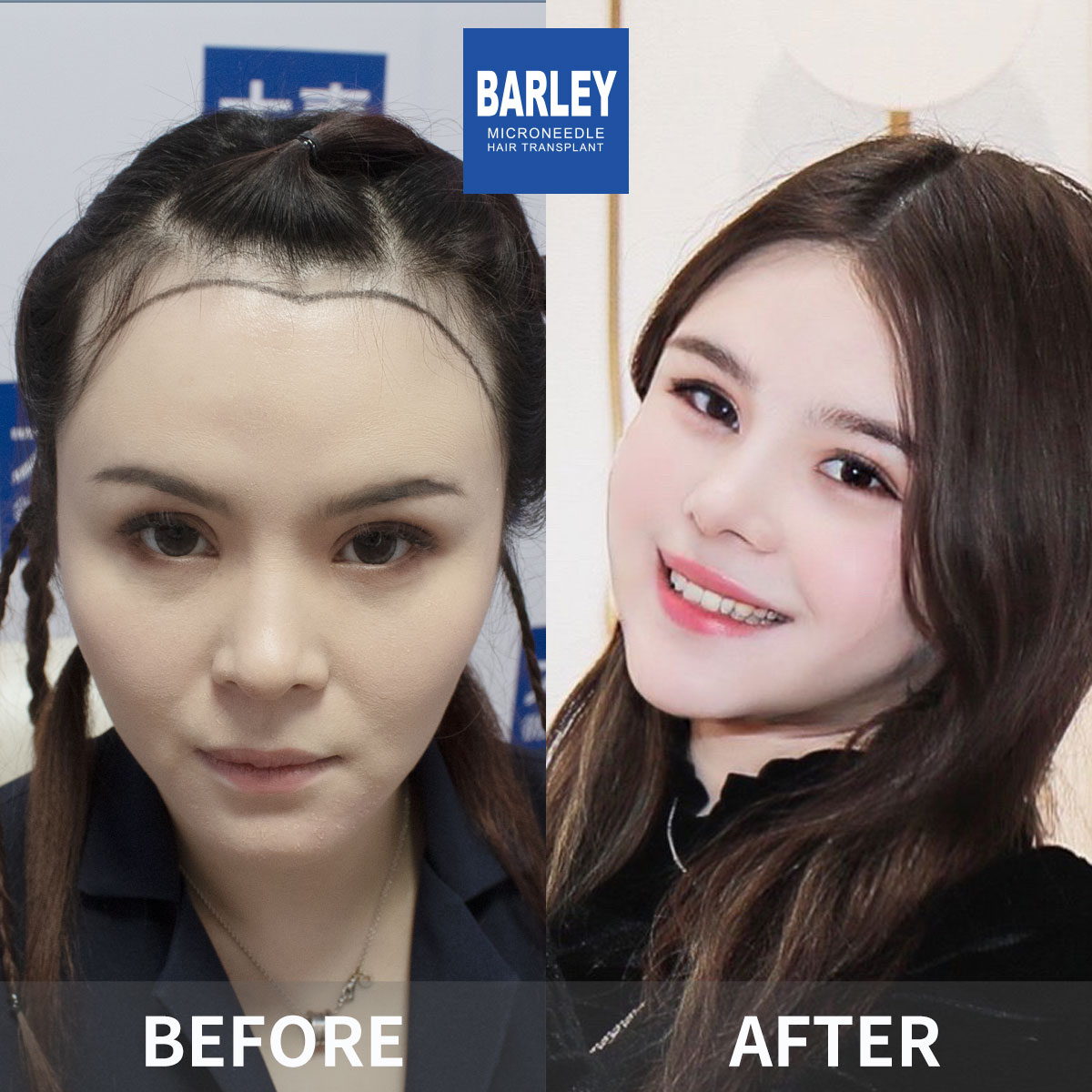 Eyebrow Transplant Before & After